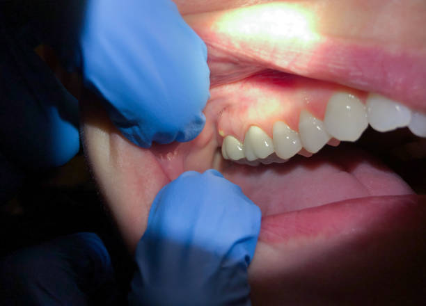 Best Emergency Care for Gum Disease in Cottage Grove, WI